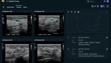 A screenshot of a breast scan reading from the See-Mode software