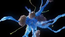 A nerve cell affected by Alzheimer's disease