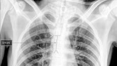 A chest x-ray showing Qure.ai's technology for breathing tube placement